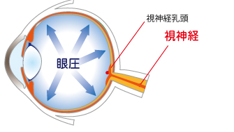 緑内障のイラスト