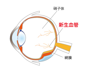 新生血管の説明イラスト